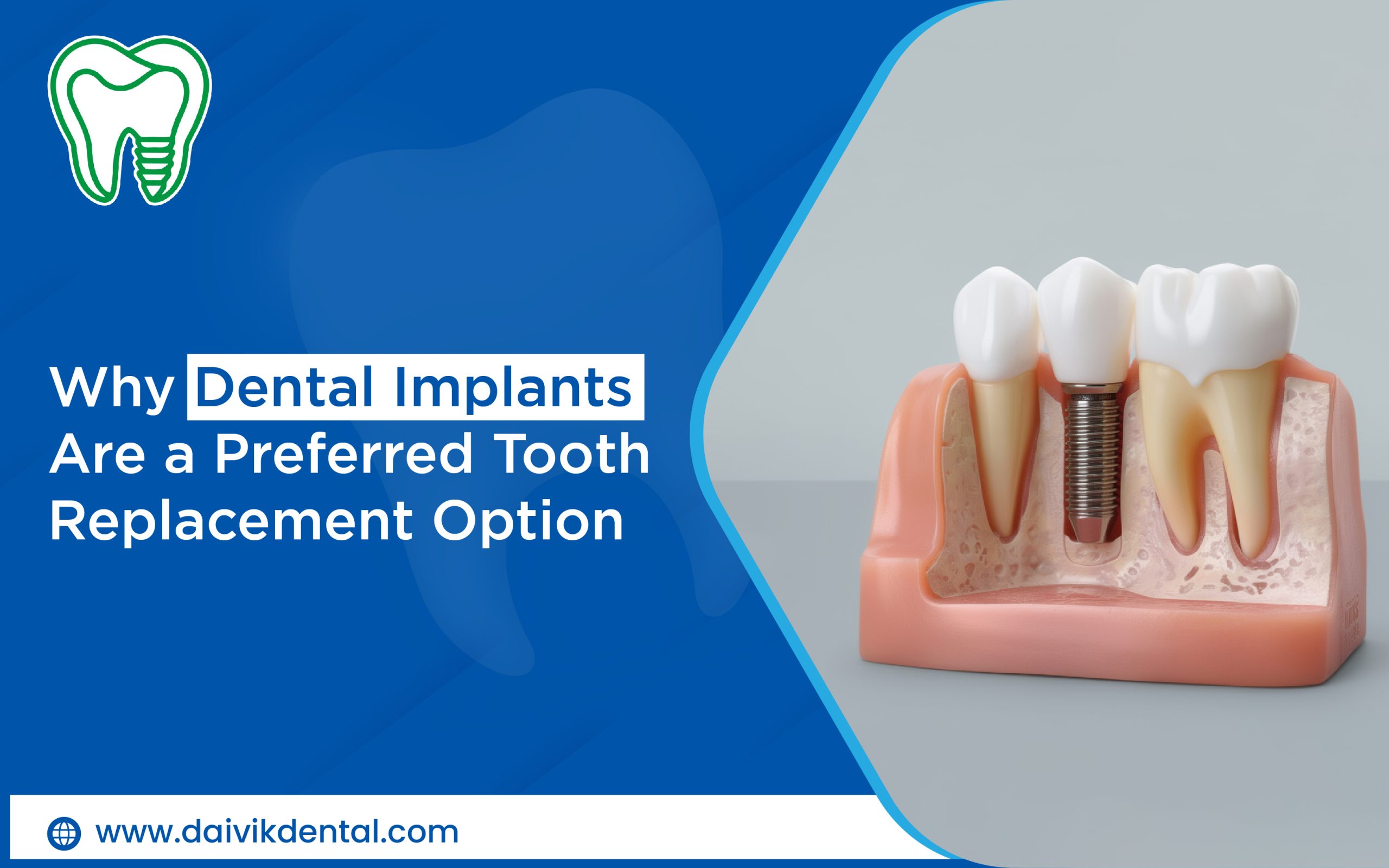 Dental Implants Treatment in Ahmedabad