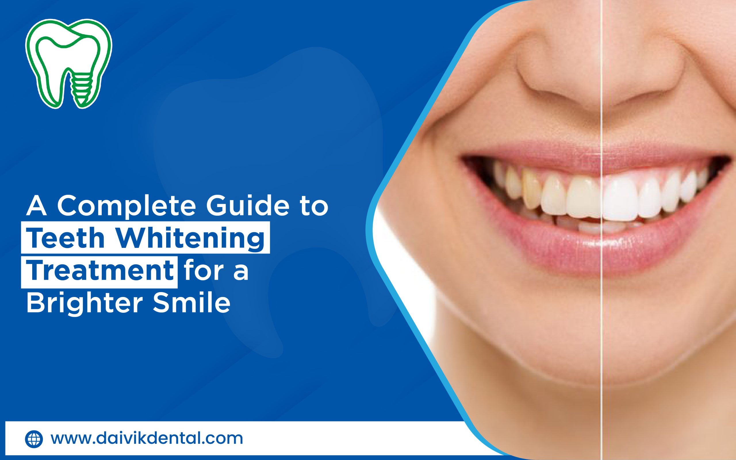 teeth whitening services in Ahmedabad