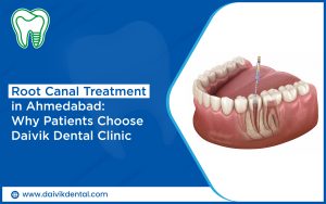 painless root canal treatment in ahmedabad